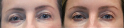 45-54 year old woman treated with Thermage - 45-54 year old woman treated with Thermage