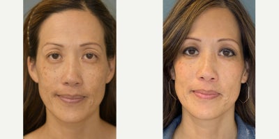 45-54 year old woman treated with BroadBand Light (BBL) - Post-ONE BBL and the results are stunning.Get rid of unwanted sun spots and even out your skin tone with our BBL (BroadBand Light) treatment.Areas to target: Face Neck Chest Back of Hands Shoulders