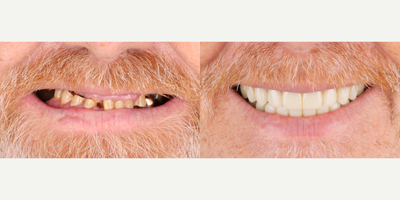 45-54 year old man treated with Dental Bonding - This patient received All-on-4 dental implants, restoring their smile with a full arch of secure, natural-looking teeth. The procedure provides lasting stability and function, allowing for an immediate transformation and renewed confidence.