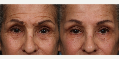 65-74 year old woman treated with Micro Botox - Before:  68 year old female would concerned by tired, angry, wrinkly appearanceAfter:  Two weeks after MicroTox injections to her forehead, upper and lower eye lids.  Note reduced forehead lines coupled with brow elevation.  With traditional intra muscular Botox, smoothing out forehead lines above the brow is not possible without a droop.  With MicroTox technique the brow elevation muscles are not weakened and the more superficial Botox treatment creates a shrink wrap effect to the eye lid skin.  Note patients under eye wrinkles are improved post Botox injection along the entire lower eye lid with reduction of the eye bags.  No fillers were used.  With traditional Botox techniques, injected into the deeper muscle of the lower lid, the opposite would happen.  There would be increased puffiness as the muscle holding back the eye lid bags is weakened.,  Not so with MicroTox which causes a shrink wrap effect of the lower eye lid skin.