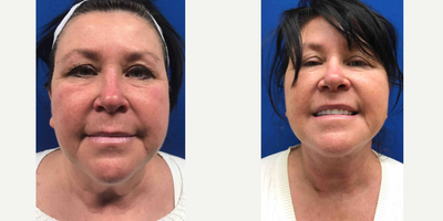 55-64 year old woman treated with Neck Lift - This woman wanted her neck skin tightened. We were able to do it under local anesthesia saving her time money and risks.
