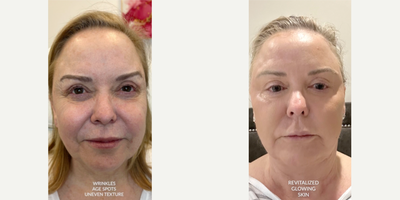 55-64 year old woman treated with Miracu, BroadBand Light (BBL), CO2 Laser - At EMER MED, Ive developed a customized approach to facial rejuvenation thats all about bringing out your best self. With a blend of advanced lasers, threads, fillers, and microneedling radiofrequency (MNRF), I target every layer of the skin to tighten, lift, and brightencreating a refreshed, natural look that my patients love. Whether its smoothing texture, boosting collagen, or restoring lost volume, I tailor every treatment plan to your unique needs, making sure you get the glowing results you deserve.