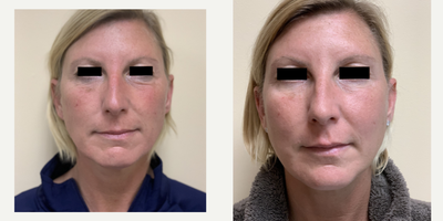 PDO Threads - Treatment with threads, dermal fillers, and Botox