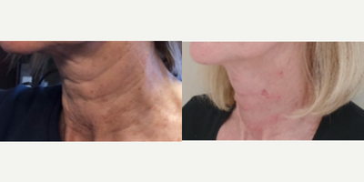 55-64 year old woman treated with Profhilo - This women was treated with Botulinum Toxin and Profhilo on the neck area : 2 sessions