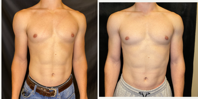 18-24 year old man treated with Evolve - This gentleman wanted more definition of his abs & chest muscle, so we did a series of Evolve Tone. This was taken at his three month follow up, when he came in to do a maintenance treatment. Evolve Tone is the latest innovation in body contouring and muscle toning. Evolve Tone works by emitting electrical muscle stimulation (EMS) to stimulate involuntary muscle contractions. Tones 4 hands-free applicators target specific muscle groups to increase muscle strength & refine the look of muscles. Every body is different and has a different treatment protocol to meet their goals. Typically at least one series of six is needed to accomplish your goals, but look at what this device can do! Totally non-invasive and zerodowntime.