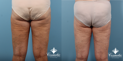 35-44 year old woman treated with Emtone - Improved appearance of cellulite after 4 treatments of Emtone