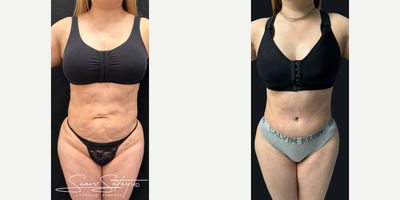 Woman treated with Umbilical Hernia Repair - Woman treated with Tummy Tuck with muscle plication as well as Umbilical Hernia Repair