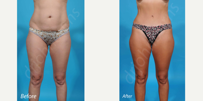 35-44 year old woman treated with Smart Lipo - bikini incision tummy tuck with 360 smart liposuction