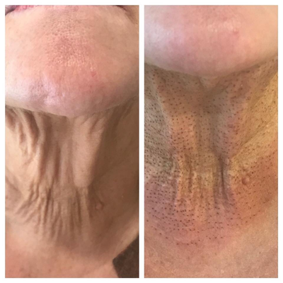 55-64 year old woman treated with Laser Treatment - Plasma Fibroblast (PlasmaLift) Neck