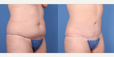 36 year old woman treated with Mommy Makeover, Breast Lift, Tummy Tuck, Strattice - 1 year after breast lift and lipo-abdominoplasty