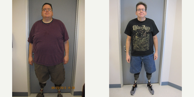 Before & After - 13 months post-op