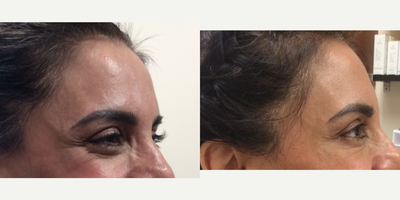 35-44 year old woman treated with Dysport Neurotoxin - Patient received Dysport Neurotoxin to the Forehead, Glabella, and Crow's Feet