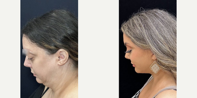 Woman treated with Deep Plane Facelift, Neck Lift, Buccal Fat Removal, Facial Fat Transfer - Woman treated with Deep Plane Facelift, Neck Lift, Buccal Fat Removal, Facial Fat Transfer
