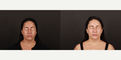35-44 year old woman treated with RHA Collection Fillers, Dermal Fillers, Botox, Dysport, Skin Rejuvenation, Skinbetter Science - Dermal Fillers, RHA under eyes to soften dark hollows and crease and Neuromodulators, Botox and Dysport were injected lower face for nasolabial folds and marionettes to gracefully refresh for facial precise aesthetic balance rejuvenation. Skin care with Skin Better Science and Stamina Cosmetics active topical ingredients helped to improve overall skin tone.