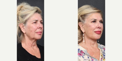 65-74 year old woman treated with Facelift, Neck Lift - face and neck lift 3 months post op.