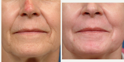 45-54 year old woman treated with CO2 Laser - concerned about lip rhitids