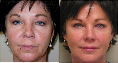 Perlane and Restylane  - Perlane and Restylane used to treat moderate volume loss of the midface, early nasolabial folds, and jowling on 48 year old patient.