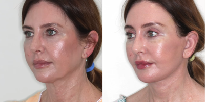 Woman treated with Neck Lift, Facelift - Deep Plane Face and Neck this surgery for overlifts has become the procedure of choice for facial rejuvenation.I have performed for 12 years and understand the nuances.This shows the Left Oblique Before / After fade at only 2 weeks post Deep Plane Face and Neck Lift and Browlift.My patient had noticed early signs of aging including loose skin on the jawline (jowls) and loose skin and soft tissue in the neck as well as heaviness of the brows and upper eyelids.She wanted to deal with these issues before they became more obvious.Now at 2 only weeks postop:Note the improvement of the jawline and neck contour. There is no redundant neck tissue. Also, note the refreshed appearance of the eyes and forehead.Those in the know understand that Deep Plane Face and Neck lifts take the tension off the skin so there is no pulled look. Deep Plane Face and Neck lifts are natural-looking because the patients' ligaments are retensioned and repositioned. The deep plane is ideal for younger or older patients.