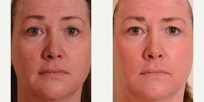 Halo Laser - Photo provided courtesy of Sciton, Inc, performed by Rebecca Gelber, MD