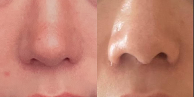25-34 year old woman treated with Alarplasty - Patient had a previous rhinoplasty with an aggressive alar base narrowing. The after photo shows reversal of the narrowing using a modified liplift procedure.