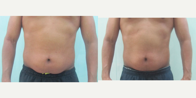 25-34 year old man treated with Exilis - A 25-year-old male complains of saggy tummy, post weight loss. Exilis was done to tighten the abdomen region.