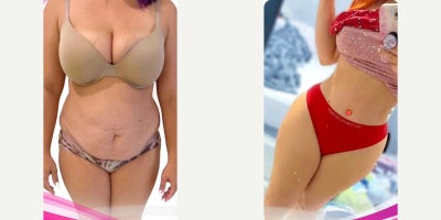 Woman treated with Tummy Tuck, Lipo 360 - Woman treated with Tummy Tuck, Lipo 360