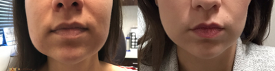 35-44 year old woman treated with Non-Surgical Neck Lift - Before and After of jawline/neck fat pad reduction with Agnes RF and Microneedling
