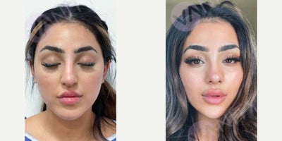 25-34 year old female treated with Buccal Fat Removal - 25-34 year old female treated with Buccal Fat Removal