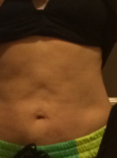 4 Weeks post Liposuction. Does this look like bad results or am I still