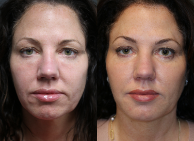 Dissolving Lower Lid and Marionette Filler - Lower lid filler dissolved and refilled, lower lip at marionette dissolved.