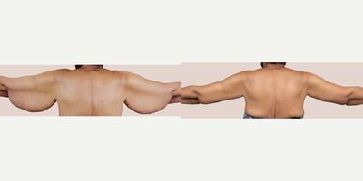 65-74 year old woman treated with Arm Lift - This patient lost weight through diet and exercise resulting in significant skin laxity. She underwent an arm lift to tighten the area.