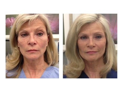 Voluma - Natural looking Voluma