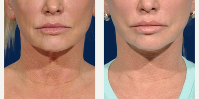 Woman treated with SMAS Facelift - Woman treated with SMAS Facelift as well as Facelift, Neck Lift with corset platysmaplasty, Lower Face/Neck Liposuction, and Buccal Fat Removal.