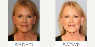 Revision Facelift - Revision Facelift to Address Looseness of Skin in Face and Jowls