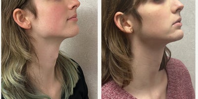 18-24 year old woman treated with Adam's Apple Reduction, Genioplasty, Facial Feminization Surgery - This lady underwent an adam's apple reduction and mandible/chin feminization.