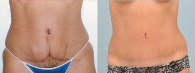 Tummy tuck disaster is saved by secondary pull - 
	At age 35, this patient had a tummy tuck by an untrained practitioner. Poorly tensioned and directed forces resulted in skin necrosis and intense scaring. I took advantage of the vertical scar and re-tentioned the abdominal wall. Now, at age fifty, she has enjoyed her save for fifteen years.
