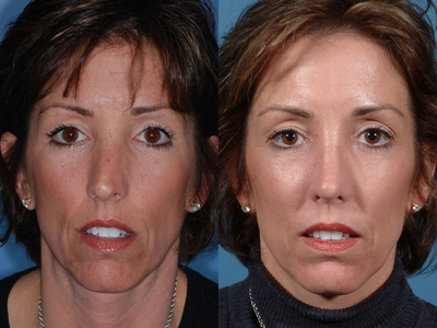 Rhinoplasty - 
	This primary rhinoplasty patient complained of breathing problems and that her nose was crooked. Her nasal problems were corrected via an open rhinoplasty approach.
