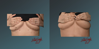 25-34 year old woman treated with Fraxel Laser - In skin rejuvenation, laser protocols with various wavelengths now offer different solutions for treating spots and scars. Considering the ratio of skin issues such as spots, veins, keratosis, freckles, warts, moles, etc., along with skin color, age, and environmental damage.