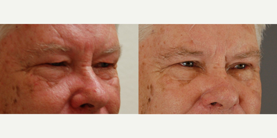 65-74 year old man treated with Eyelid Surgery - Upper eyelid surgery performed by Dr. Bryson Richards.