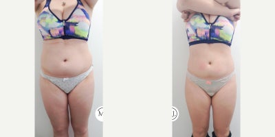 35-44 year old woman treated with Velashape - Patient treated with VelaShape II for non-invasive body contouring and cellulite improvement. The treatment combines radiofrequency, infrared light, vacuum, and mechanical massage to stimulate circulation, improve skin firmness, and reduce localized fat and cellulite.This patient completed 8 weekly sessions, resulting in visible improvement in skin texture, firmness, and body contour. VelaShape is a non-invasive procedure with minimal downtime, commonly used to reduce cellulite and improve the appearance of areas such as the abdomen, thighs, and buttocks.