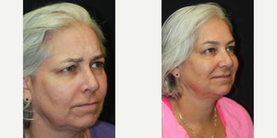 50 year old woman treated with Botox for Migraines - 50 year old woman seeking to address early signs of aging consulted with Dr. Kris Reddy FACS. Dr. Reddy performed Botox about 40 units and dermal fillers (1 syringe of Juvederm Ultra in the nasolabial folds and perioral lines and 1 syringe of Voluma for the lower face and chin area). Patient wanted to have Botox performed for cosmetic reasons and to treat migraine headaches.