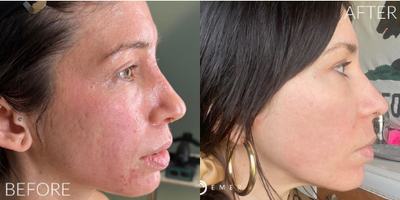 Woman treated with Bellafill, DeepFX, ActiveFX, PlasmaMD - Woman treated with Bellafill, DeepFX, ActiveFX, PlasmaMD