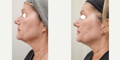 55-64 year old woman treated with IPL, Sylfirm X, Lip Fillers, Ultherapy, Alastin Skincare, Dysport - She started her Beauty Journey on January 31st 2024. She wanted to improve her skin quality in a natural and less invasive way. Her neck was a priority.We started with Ultherapy, 3 combined lasers (IPL plus vascular), Dysport, lip filler and then 3 SylfirmX face and neck treatments. She is using Alastin skincare