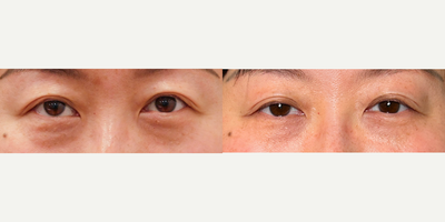 Morpheus8 Prime for Under Eyes - Morpheus8 Prime is excellent for under-eye treatments, effectively targeting fine lines, wrinkles, sagging or puffy skin in this delicate area. The radiofrequency energy produced by Morpehus8 penetrates deeply to stimulate collagen and elastin production, promoting significant remodeling that results in tighter, smoother, and more refined skin.