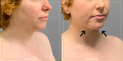 25-34 year old woman treated with AirSculpt - This patient achieved a dramatically improved profile, removed fullness in her neck, and restored a new youthful appearance three months following Chin AirSculpt.