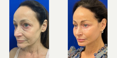 56 year old woman treated with Laser Resurfacing - 56 year old woman treated with Laser Resurfacing through CO2 Laser as well as Eyelid Surgery through upper and lower blepharoplasty, Facelift, Neck Lift, and Facial Fat Transfer, shown 8 months post op.