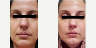 35-44 year old woman treated with Botox - Before and after Botox to forehead and between eyebrows. Juvederm to folds beneath the nose and above the lips --