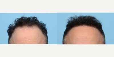 25-34 year old man treated with FUE Hair Transplant, Hair Transplant, Hair Loss Treatment, PRP for Hair Loss, NeoGraft - This patient wanted to rebuild his hairline and add density. Dr. Wise performed an FUE hair transplant using 3,030 grafts. On the day of the procedure, the patient also underwent a treatment of PRP to strengthen the follicles and expedite healing. Six months post-op, the patient is loving his results and progress!
