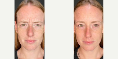 25-34 year old woman treated with Jeuveau, Botox - This client had Jeuveau to help soften her fine lines.