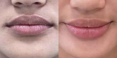 27 year old woman treated with Restylane Defyne, Restylane Contour - This 27-year-old patient received 1 syringe of Restylane Kysse and 1 syringe of Restylane Defyne, enhancing lip volume, definition, and hydration for a fuller yet natural-looking result.
